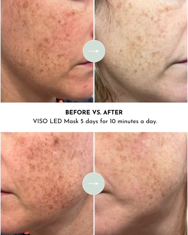 VISO Red Light Therapy Mask — 470 MICRO-LEDs, FDA Cleared